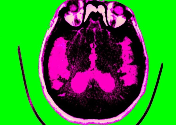 Scientists are finally starting to figure out Alzheimer’s