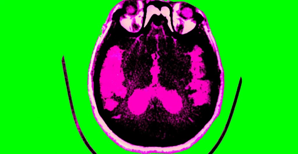 Scientists are finally starting to figure out Alzheimer’s