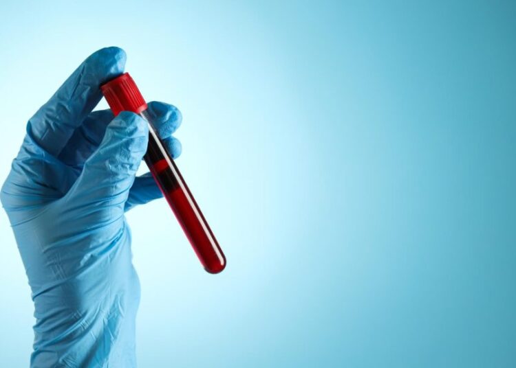 Who Should Get a Blood Test for Alzheimer’s Disease?
