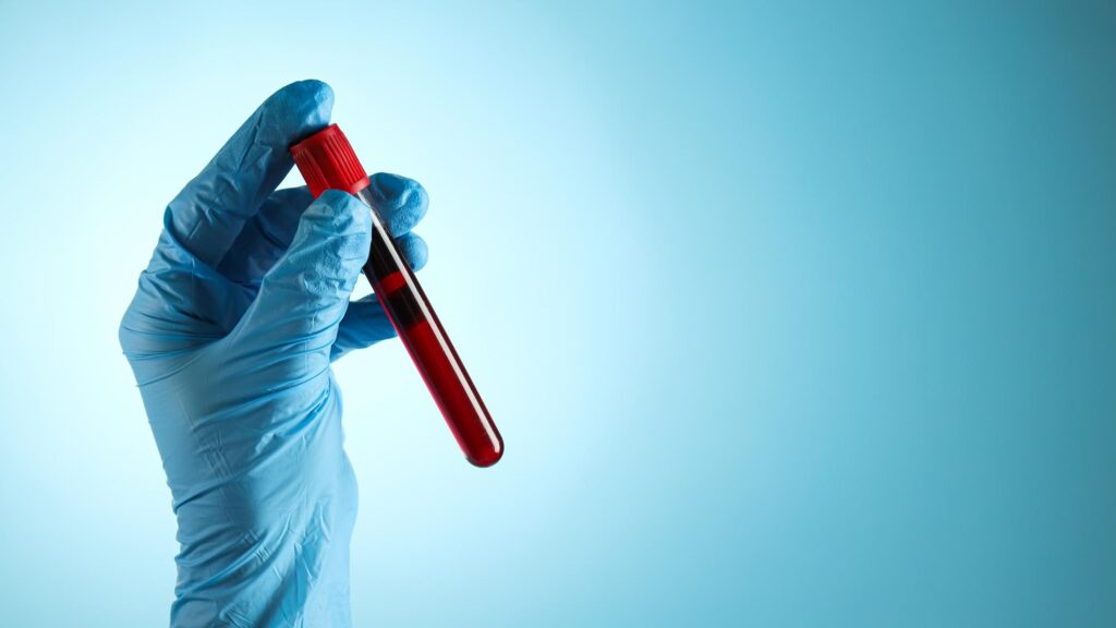 Who Should Get a Blood Test for Alzheimer’s Disease?