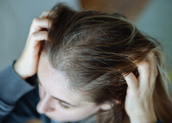 3 common health conditions that can cause hair loss in women