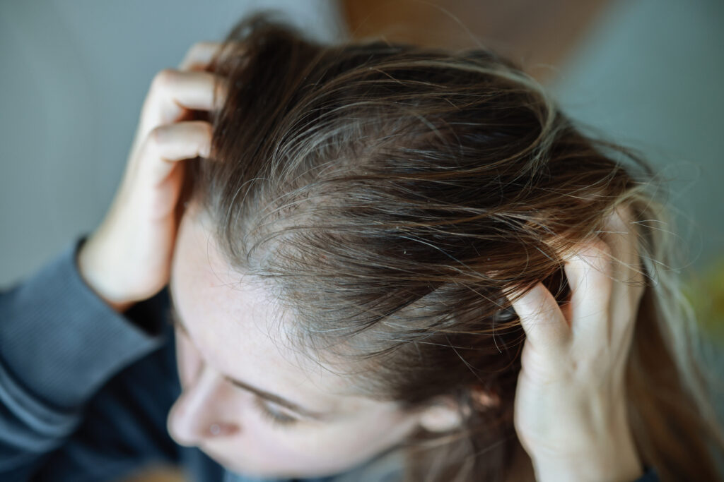 3 common health conditions that can cause hair loss in women