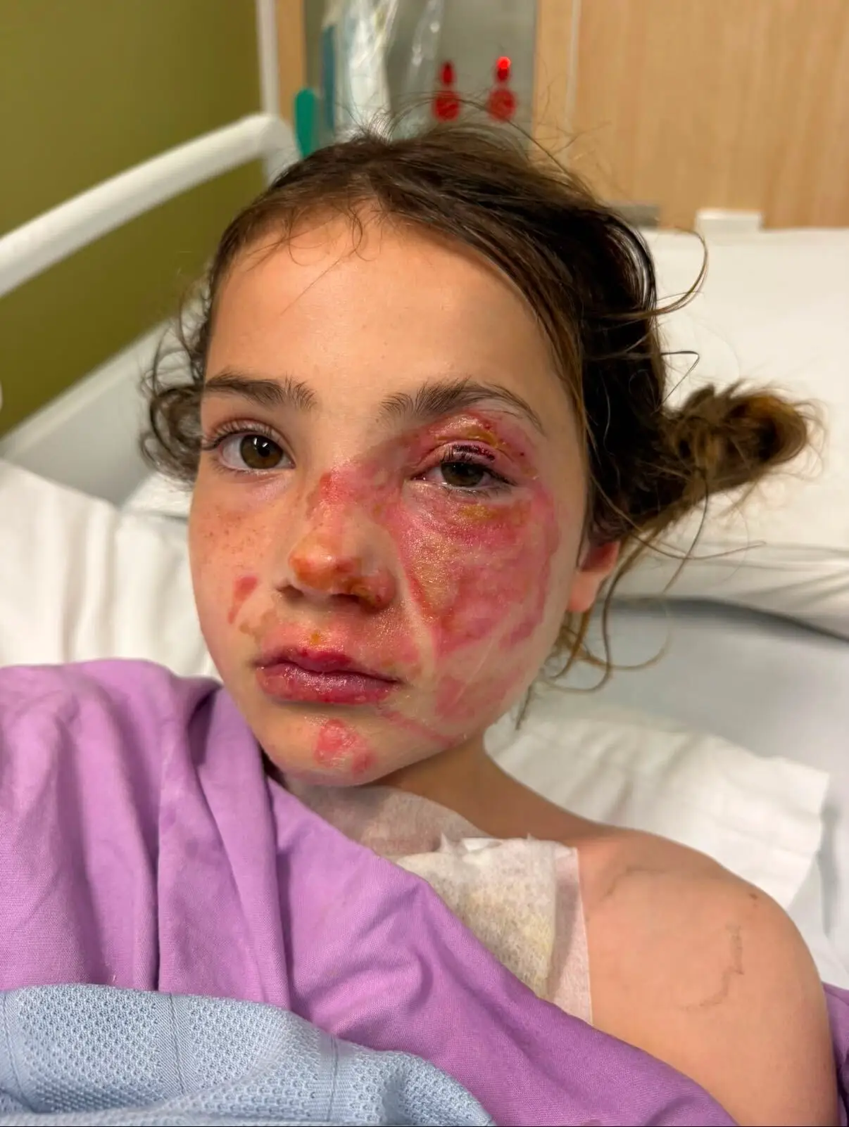 Violet Zerbst, 10, suffered burns on her face and body after a squishy toy exploded.