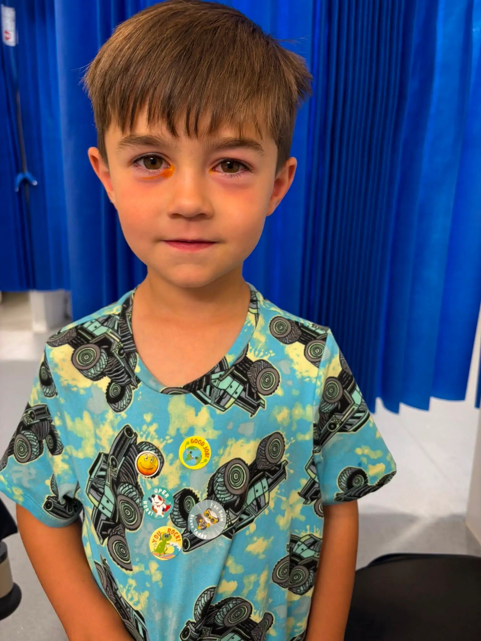 Hudson, 4, had to be sedated for further eye washes.