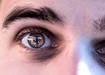 Do You Have ‘Ferritin Face’? Here’s What It Looks Like and What to Do About It.