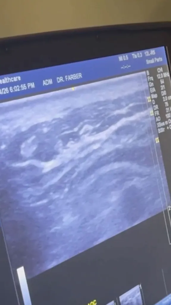 An ultrasound screen showing an image of an internal body part, with