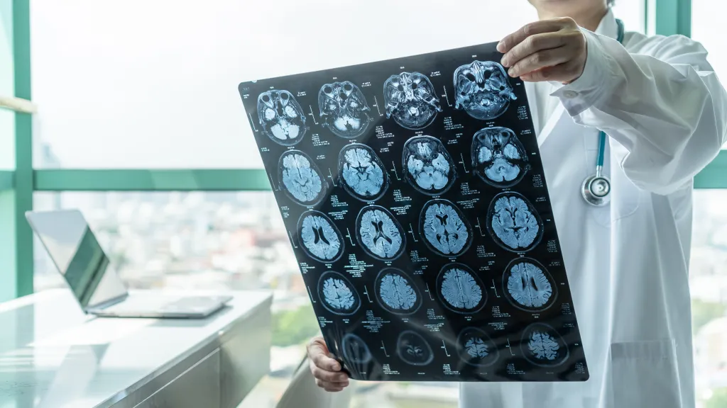 A medical doctor holds up an MRI film showing slices of a patient's brain.