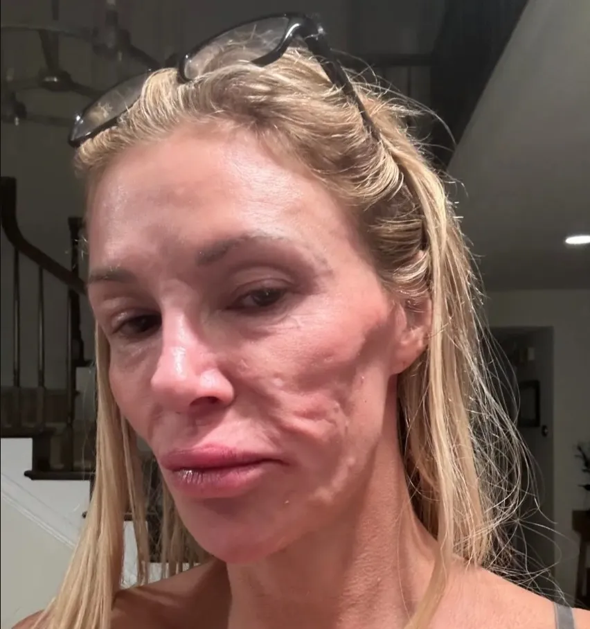 Brandi Glanville with visible facial scars and swelling.