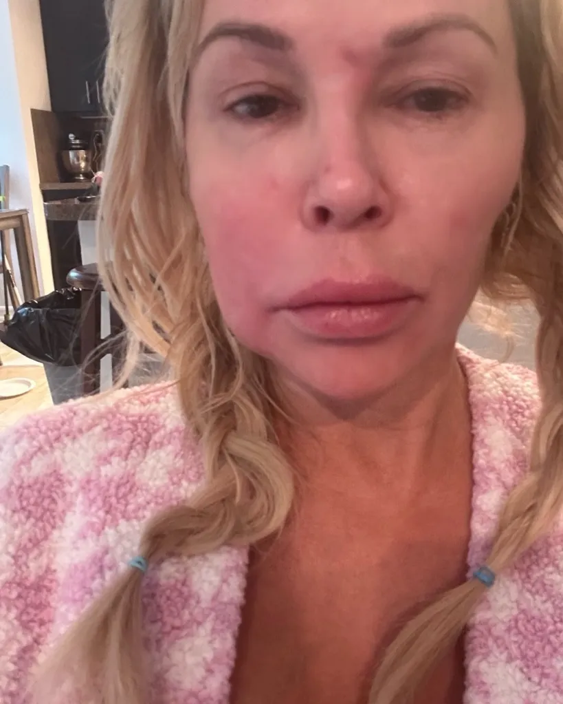 Brandi Glanville with a swollen and red face due to a mystery facial parasite.