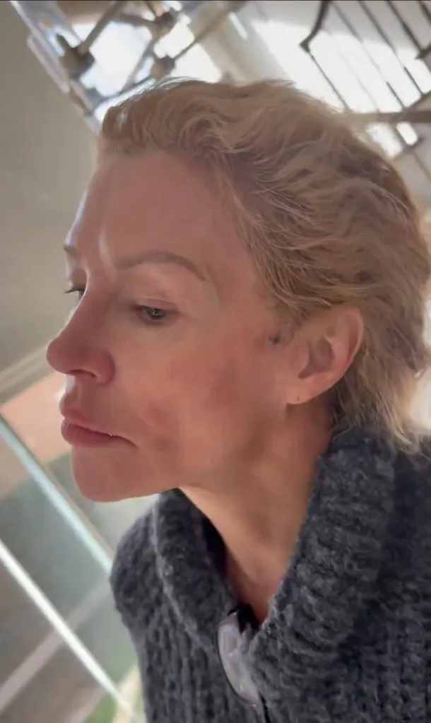 Brandi Glanville shakes rapidly while undergoing treatment for a facial parasite.