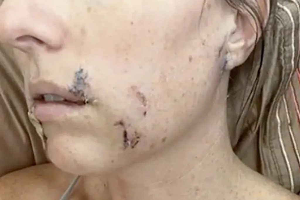 Brittany Cardinal, a woman who fought off a coyote, with scratches to her face
