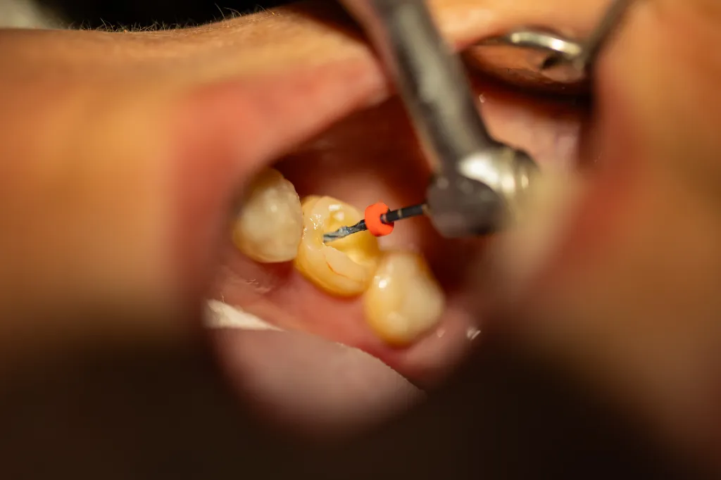 Leone said he ordered his dentist to perform a root canal without Novocaine -- despite being told, “You’re out of your mind.”