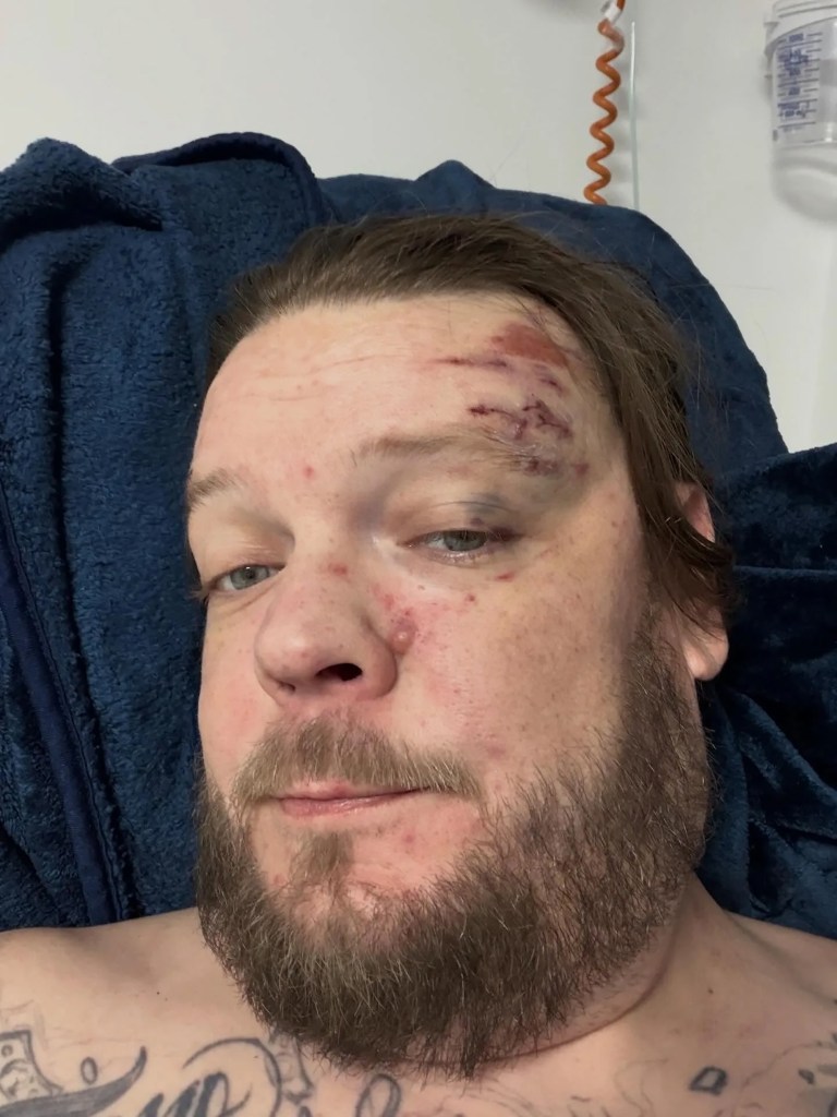 Corey Harrison with visible injuries to his face, including cuts and bruising around his left eye and forehead.