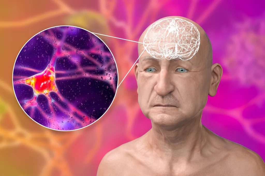 Illustration of an elderly man with a translucent brain and a magnified image of an impaired neuron.