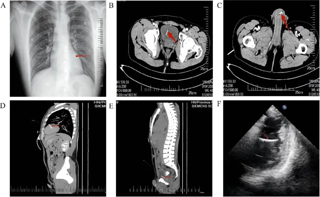 Collage of medical imaging scans showing foreign bodies in a patient's chest, pelvis, bladder, and penis.