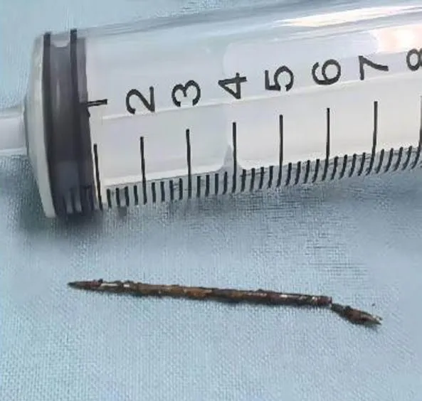 A foreign body, possibly a thin, rusty nail, next to a syringe for scale.