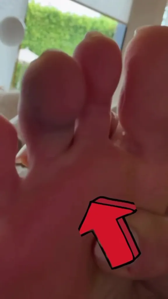 Giada De Laurentiis's foot with a red arrow pointing to her bruised toe.