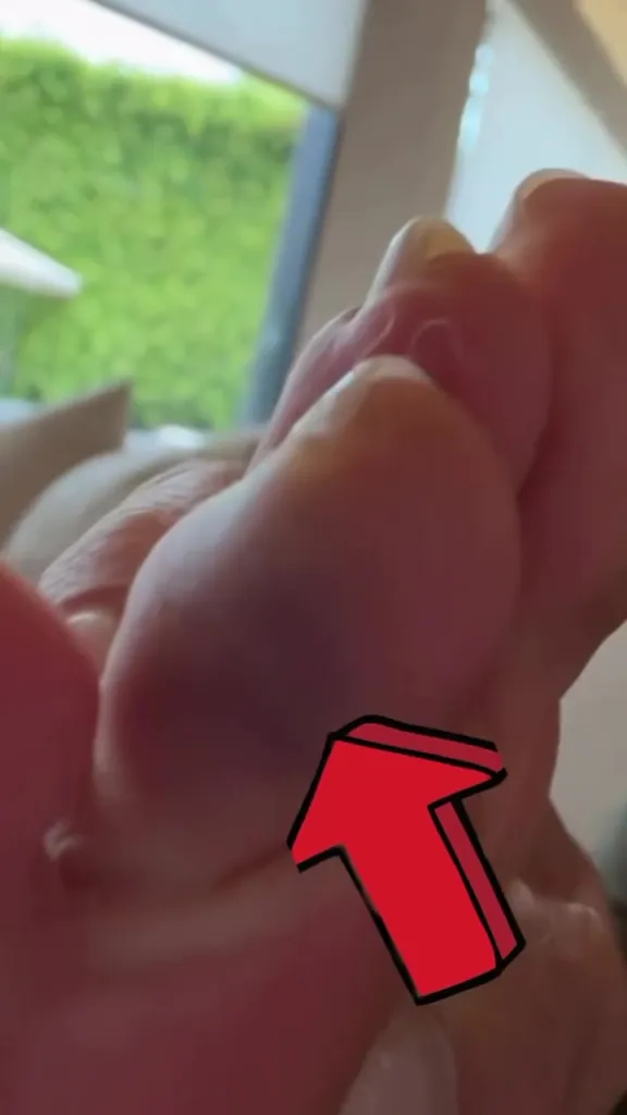 A foot with a red arrow pointing to a bruised toe.