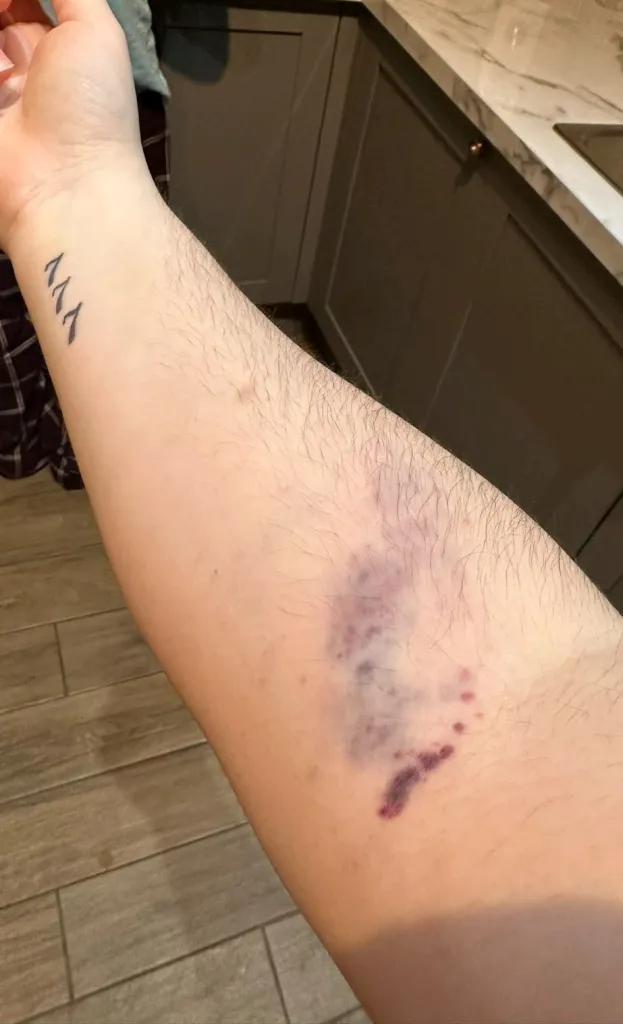 Megan Wright's arm showing large, unexplained bruises.