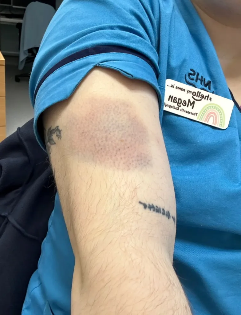 Bruising on the arm of Megan Wright.