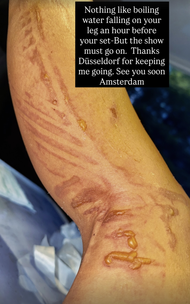A leg with burns and blisters from boiling water.