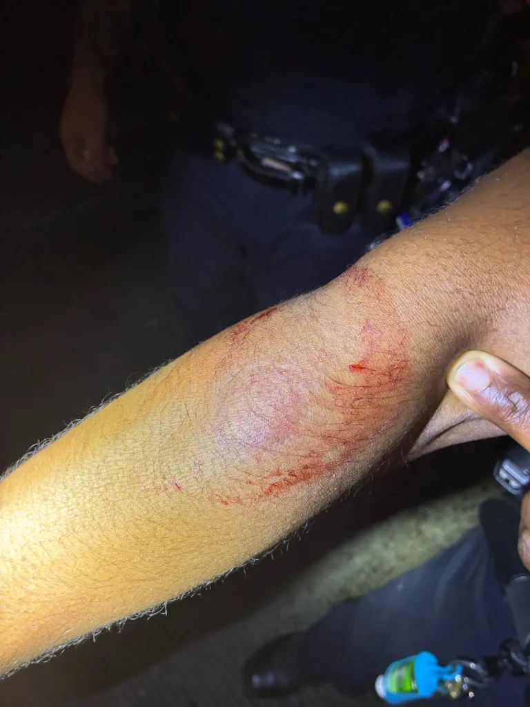 Injuries on the arm of a female sergeant, including a bite mark, scratches, and blood.