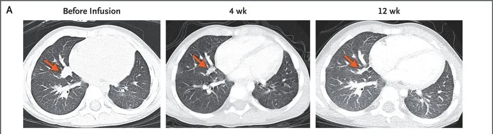 Collage of three CT scans showing a hepatoblastoma tumor shrinking after CAR T cell treatment.