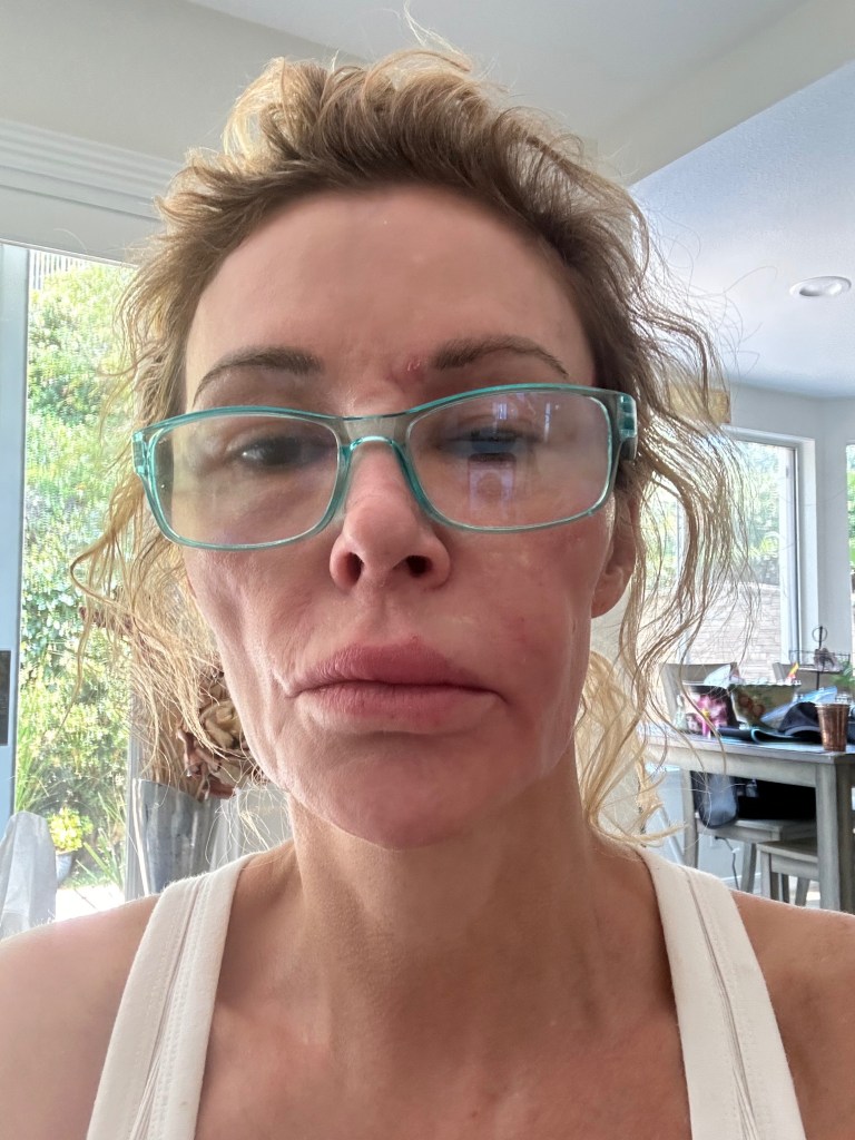 A close-up of Brandi Glanville's face shows red, peeling skin, swollen lips, and a red bump between her eyebrows, as she recovers from a second-degree burn.
