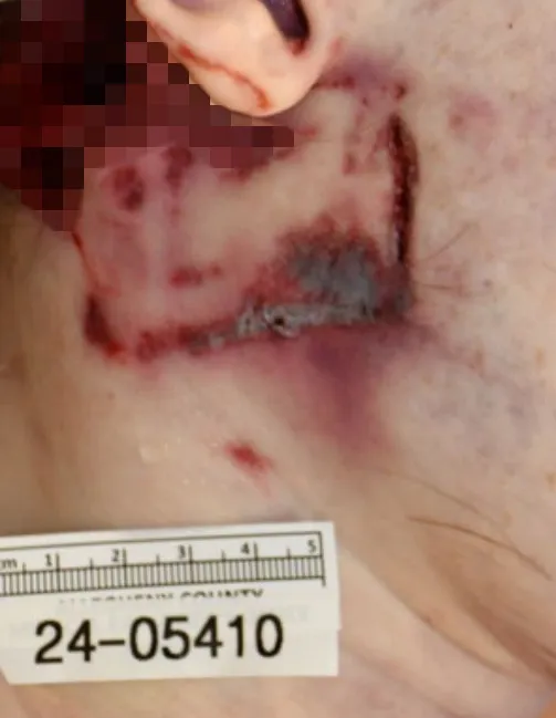 Autopsy photograph showing the patterned abrasion and exit wound on Crooks' right lateral neck.