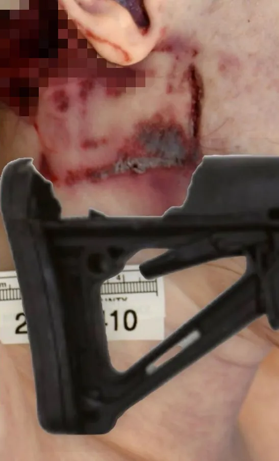 An overlay image aligning the angular shape of a damaged rifle buttstock with a patterned neck injury.