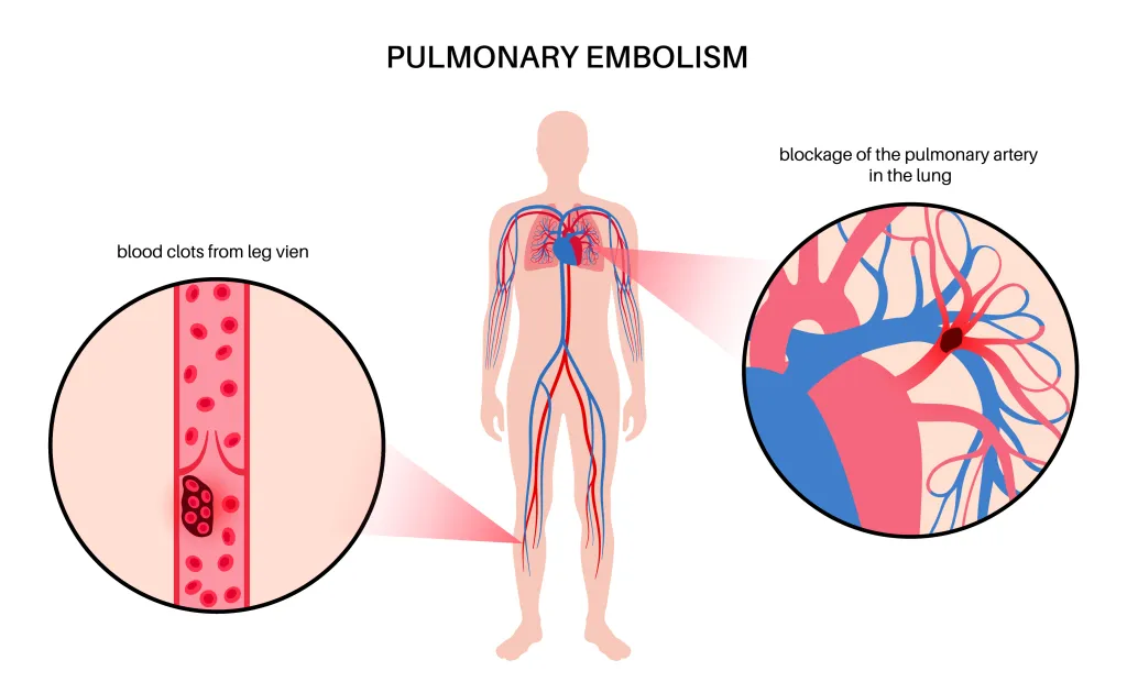 Illustration of a pulmonary embolism, showing a blood clot originating in a leg vein and traveling to cause a blockage in the pulmonary artery in the lung.