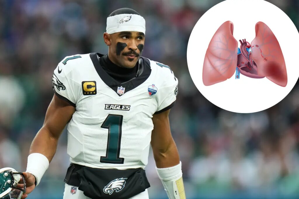 What is pulmonary embolism? The serious blood clot condition sidelining Jalen Hurts