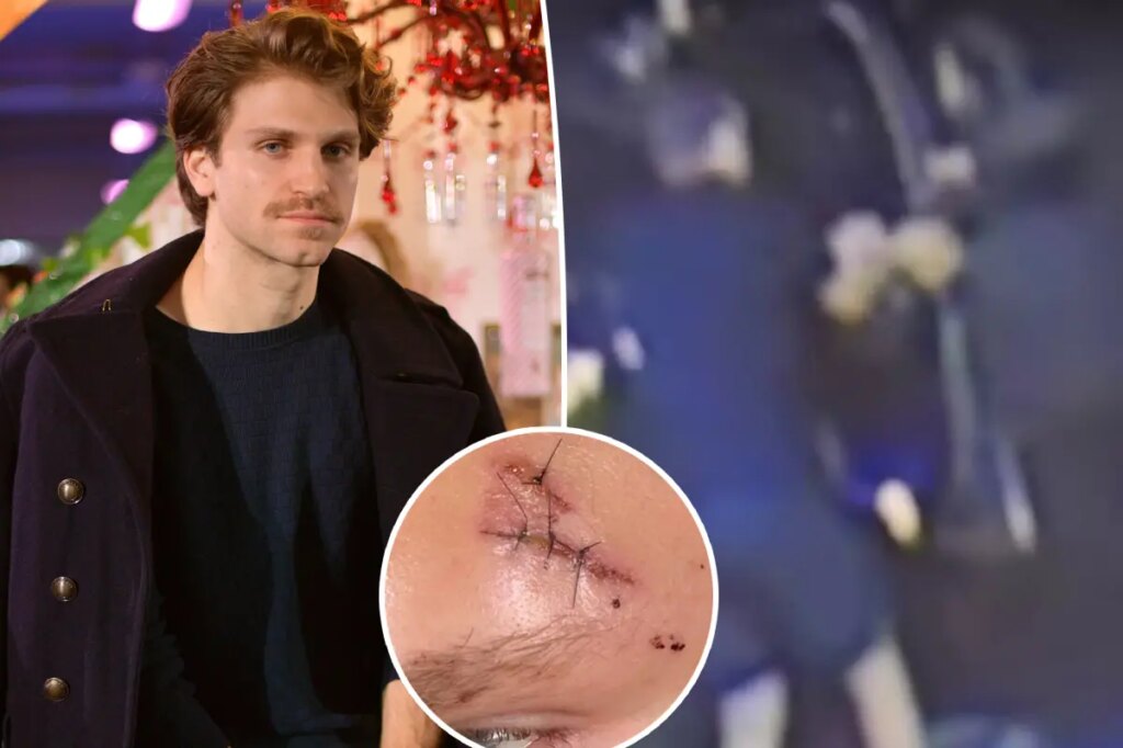 ‘Pretty Little Liars’ star Keegan Allen shows off battered, stitched-up face after brutal attack in LA