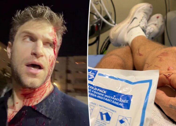 Keegan Allen posts painful photo after getting brutally robbed in LA: ‘I’m on the mend’