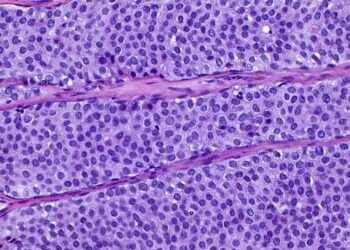 I’m an oncologist. Here’s what to know about DCIS or Stage 0 breast cancer.