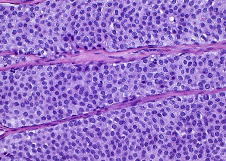 I’m an oncologist. Here’s what to know about DCIS or Stage 0 breast cancer.