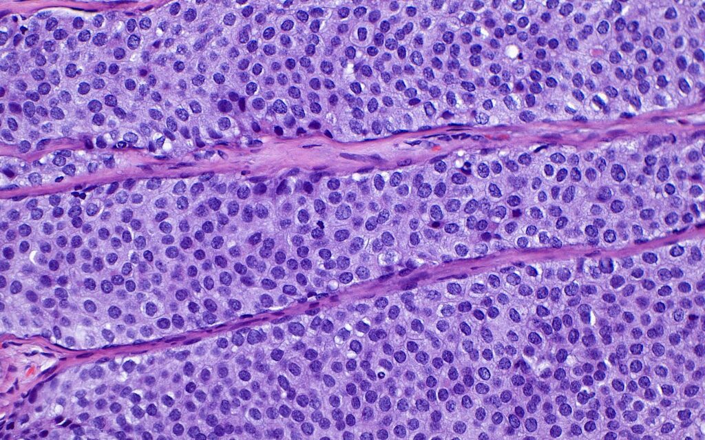 I’m an oncologist. Here’s what to know about DCIS or Stage 0 breast cancer.