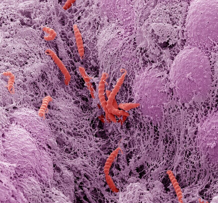 These common infections can cause cancer. Here’s what can lower your risk.