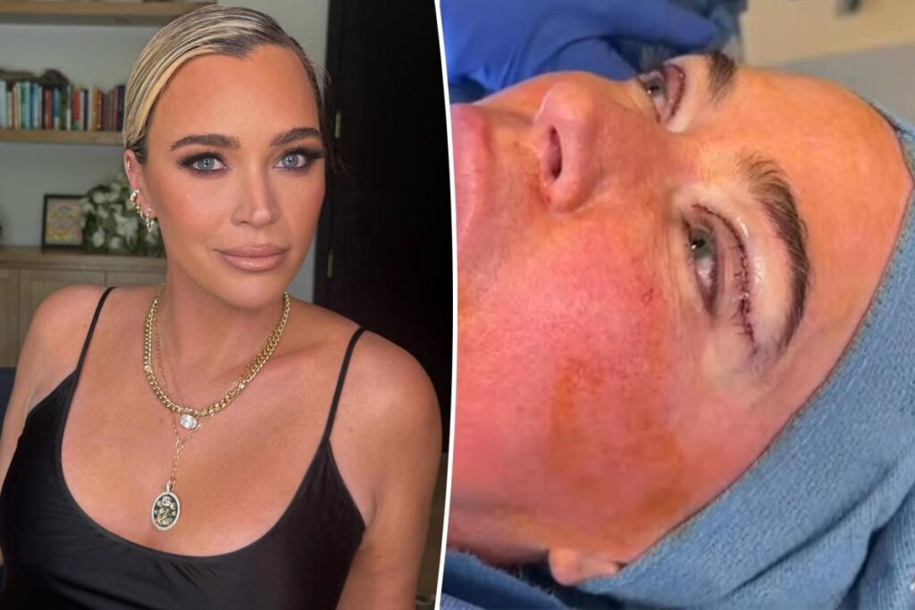 Teddi Mellencamp defends undergoing plastic surgery procedure during stage 4 cancer treatment