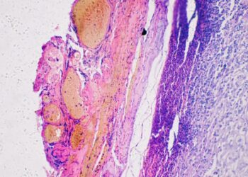 A Personalized Cancer Vaccine Lowers Melanoma Recurrence by 42%