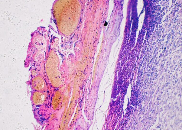 A Personalized Cancer Vaccine Lowers Melanoma Recurrence by 42%