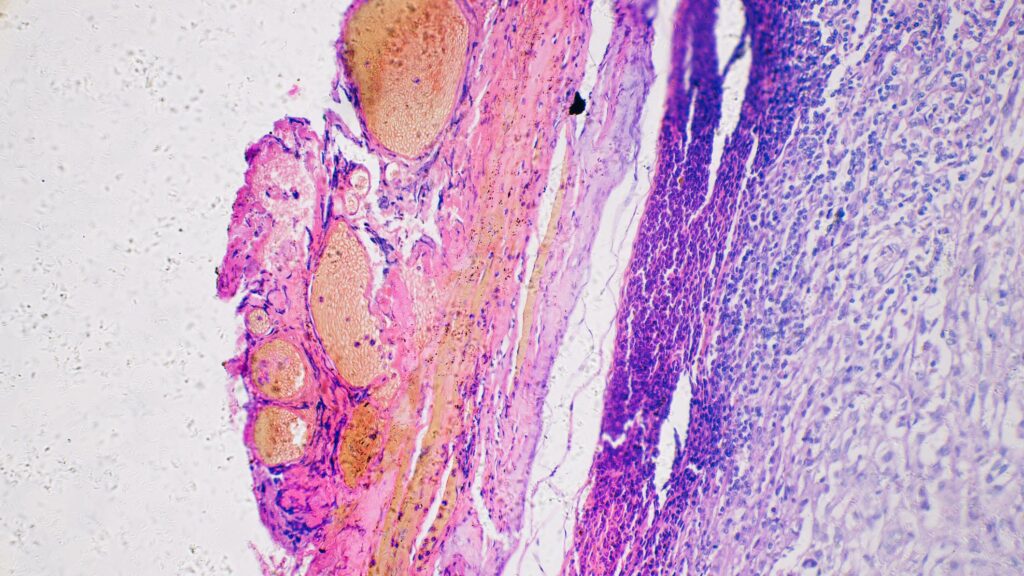 A Personalized Cancer Vaccine Lowers Melanoma Recurrence by 42%