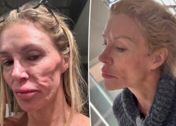 Brandi Glanville to get ‘face taken off’ for under-skin ‘power wash’ to remove parasite