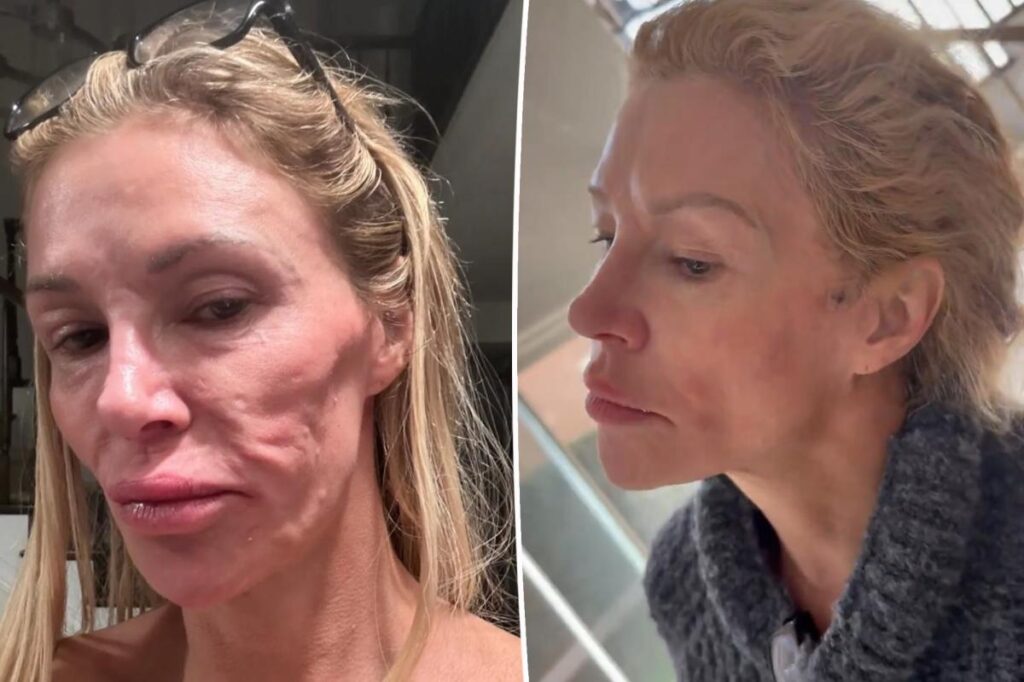 Brandi Glanville to get ‘face taken off’ for under-skin ‘power wash’ to remove parasite