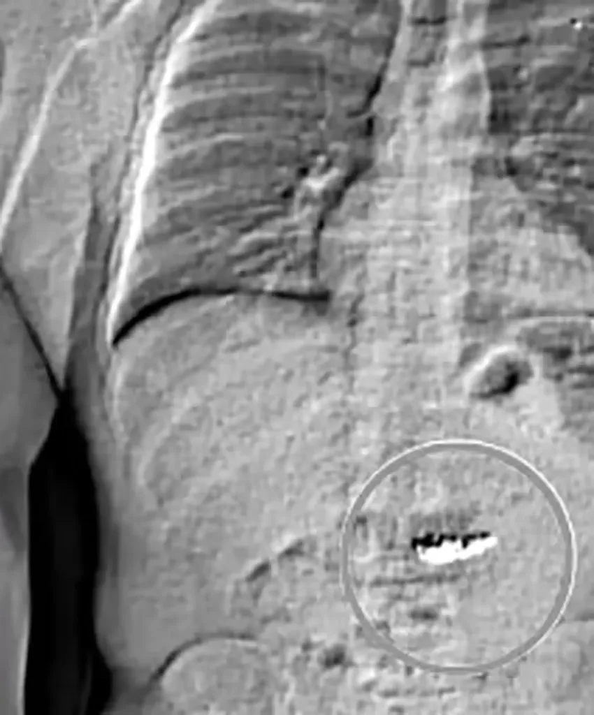 X-ray scan showing jewelry swallowed by Jaythan Lawrence Gilder in his abdomen.