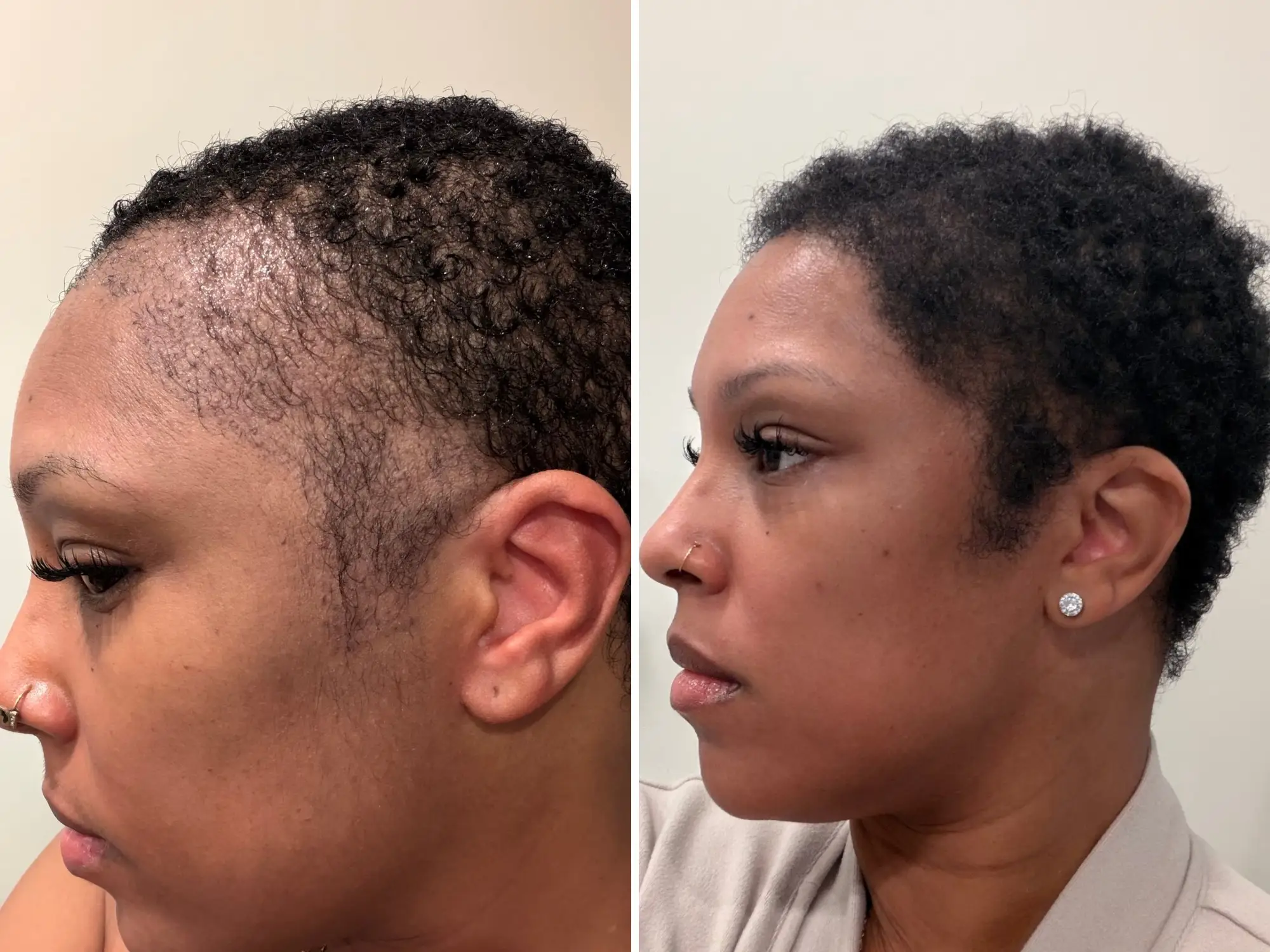 A woman before and after a hair translant