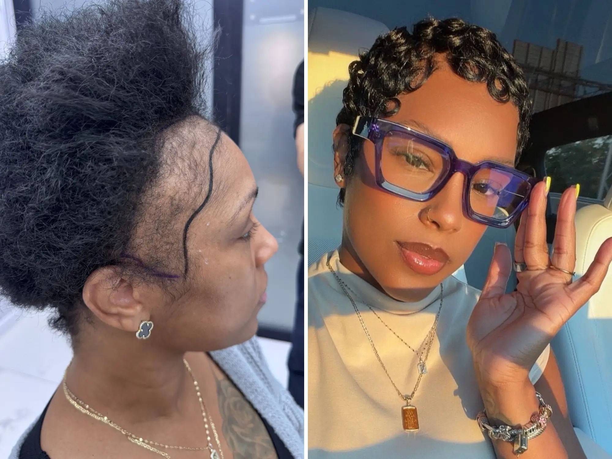 A woman before and after her hair transplant.