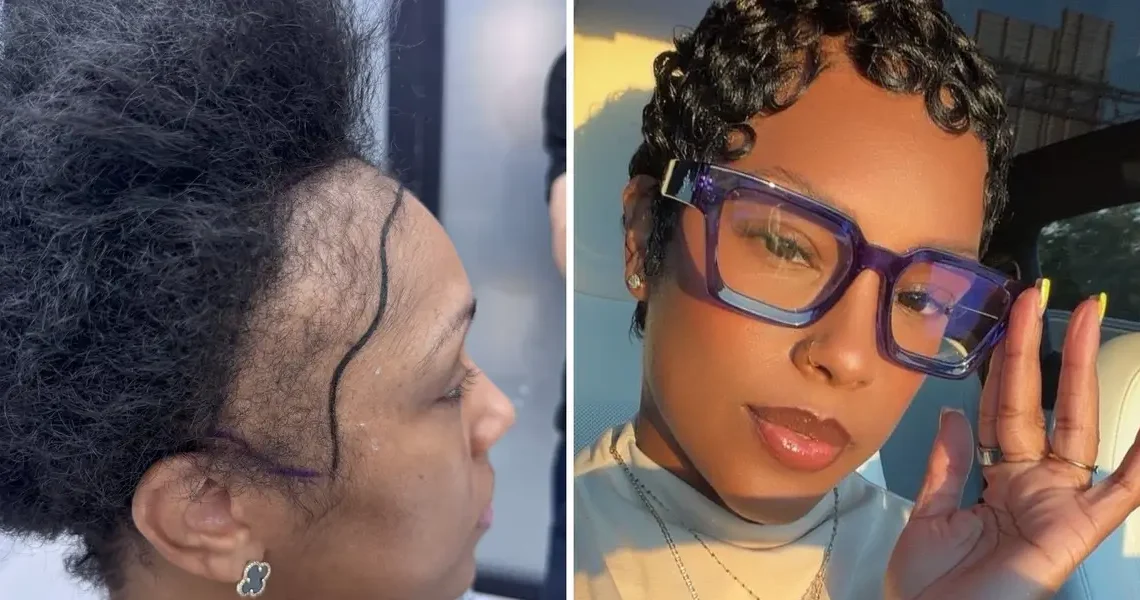 I couldn’t afford a $13,000 hair transplant in the US. So I flew to Turkey and I love the results.