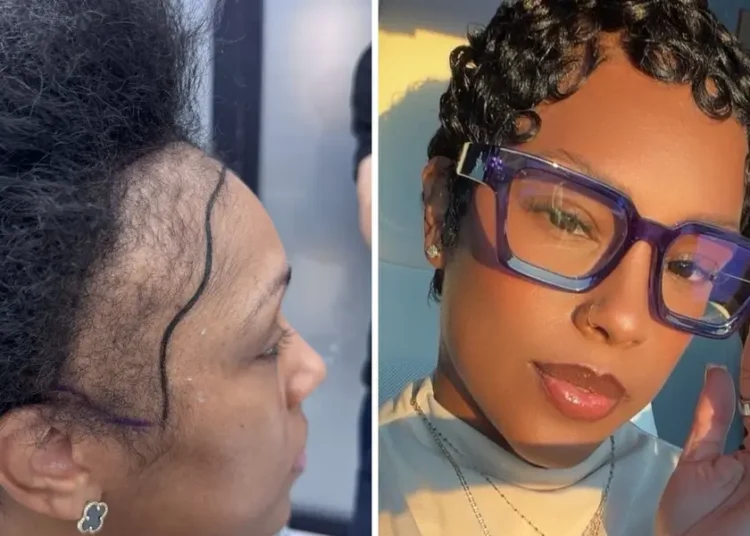 I couldn’t afford a $13,000 hair transplant in the US. So I flew to Turkey and I love the results.