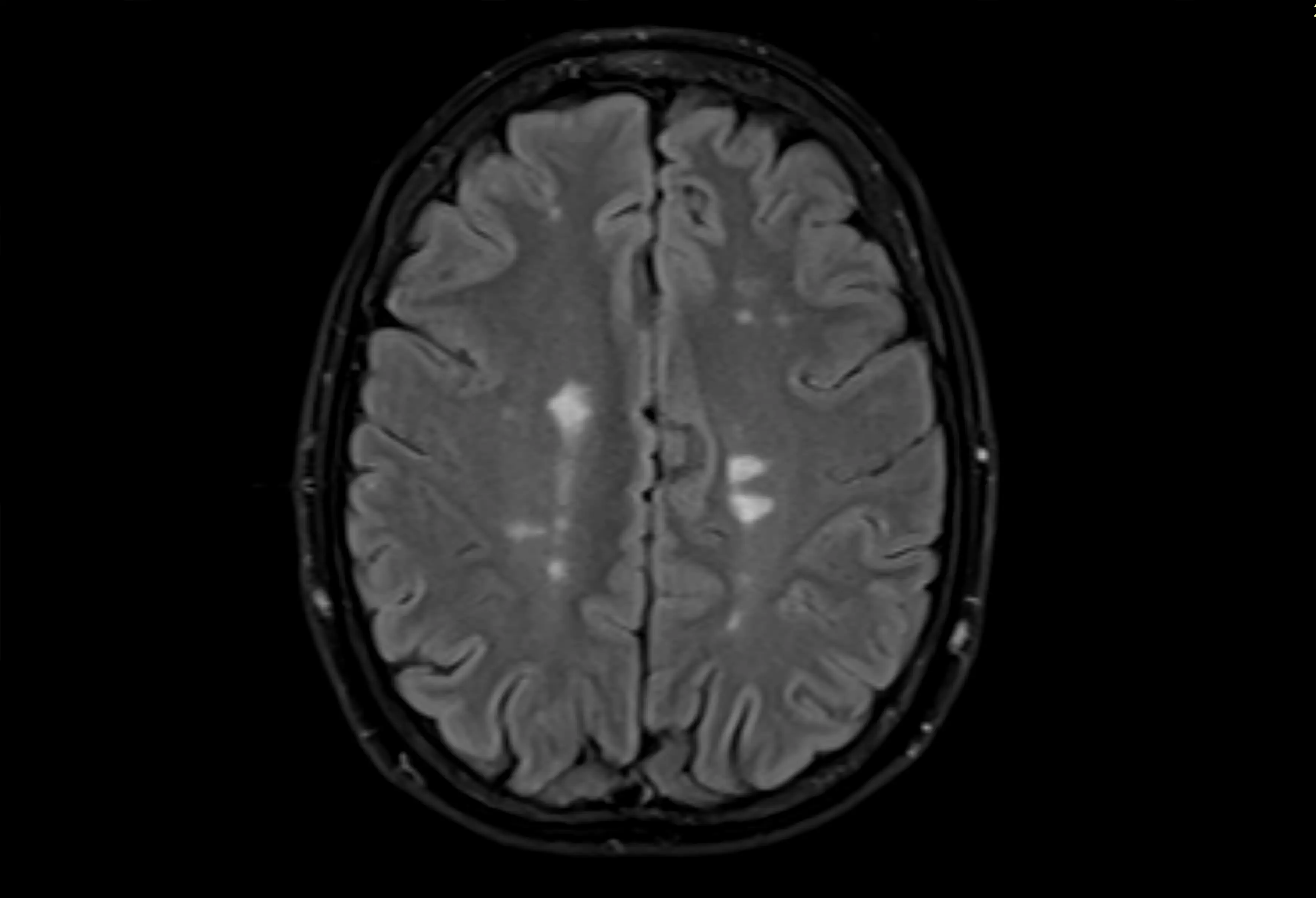 MRI image of the brain showing multiple sclerosis plaques